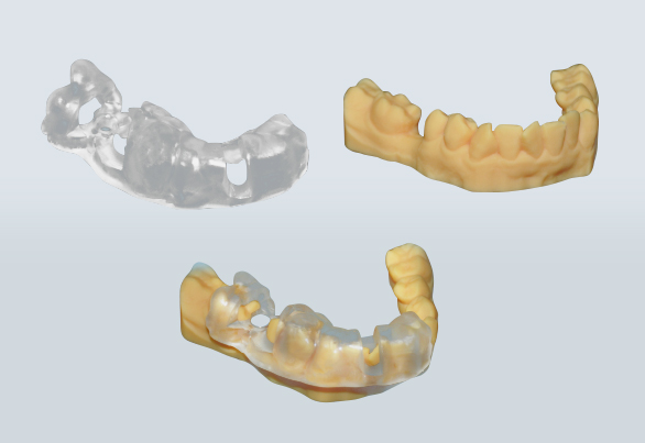 Narrow diameter implant in posterior Mandible